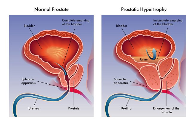 Adenom de prostată (hipertrofie benignă) – ce înseamnă și cum se tratează?